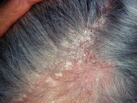 seborrheic dermatitis pictures